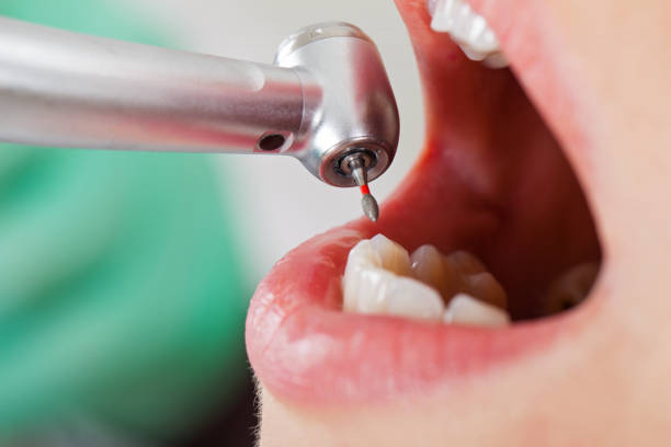 Best Emergency Tooth Extraction in Clayton, IN